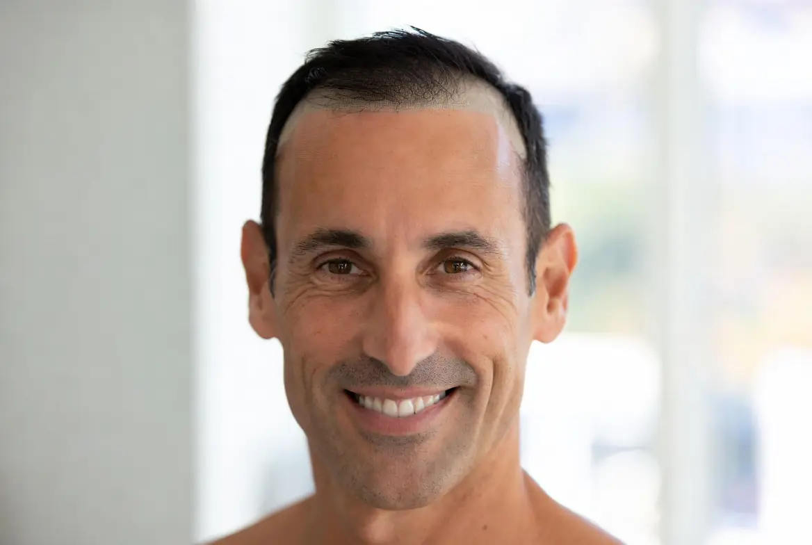 Confident client after hair replacement at Yati Hair Wig